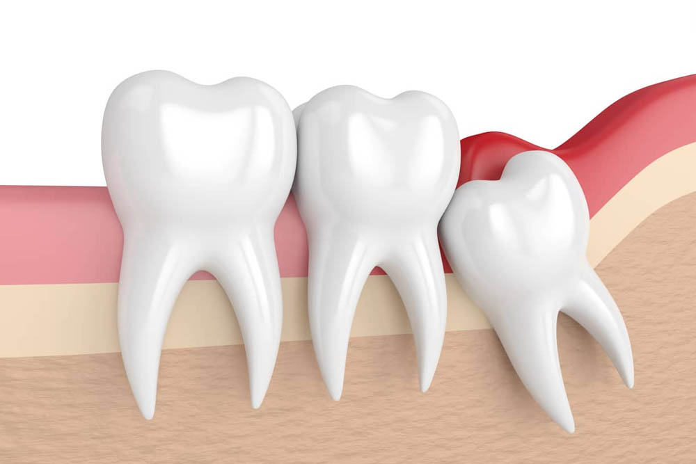 Impacted Tooth Removal/ Painless Surgical Extraction